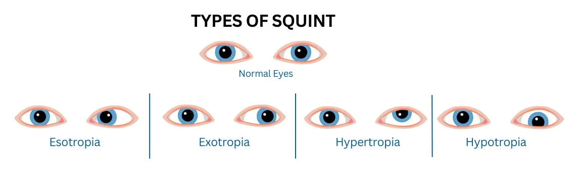 types of squint